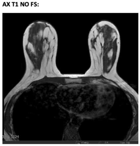 MR Bilateral Breasts WWO Protocol | OHSU